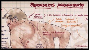 ¿Qué es la Espondilitis Anquilosante? La enfermedad que afecta a Johnny Herrera