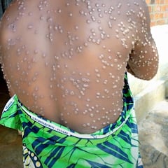 Así es la nueva cepa de la viruela del mono que se está expandiendo en África: síntomas y cómo se transmite