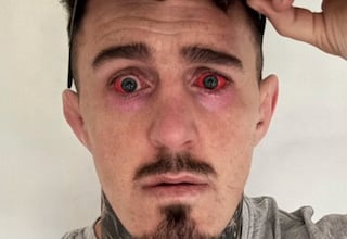 La impactante imagen de Tom Aspinall tras su operación de ojos