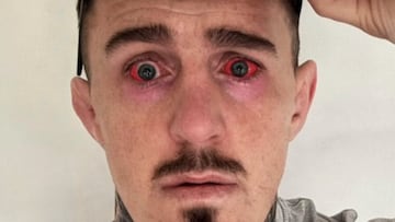 Tom Aspinall tras su operación ocular.