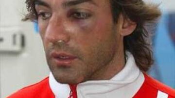 <b>DURO GOLPE.</B> Además de la fractura de los huesos propios de la nariz, Javi Navarro sufrió la desviación del tabique nasal.