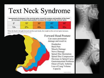 S&iacute;ndrome de Text Neck, que puede provocar molestias en el cuello