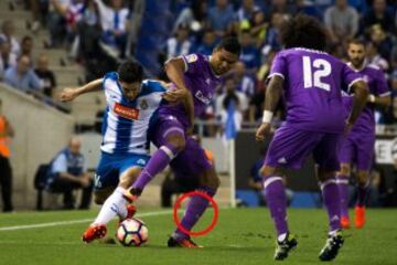 Fisura en el tercio medio del peroné izquierdo.