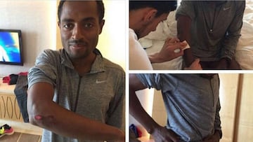 Bekele muestra sus heridas.