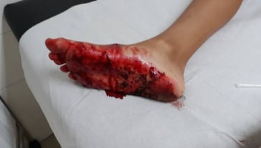 Un tiburón ataca a un niño que surfeaba en Gran Canaria