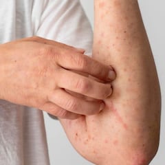 Brote de Sarampión en Jalisco 2026: municipios con más contagios, medidas preventivas y muertes