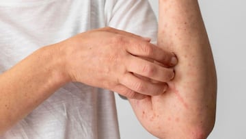 Jalisco ocupa el primer lugar nacional con más contagios de sarampión. Llaman a utilizar obligatoriamente el cubrebocas y vacunarse.