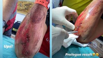 El brazo de Laia Sanz tras su ca&iacute;da en el Rally de Andaluc&iacute;a.