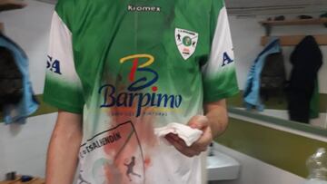 Imagen del jugador del Barpimo-Futsalhendín que fue agredido en el labio en el vestuario por un jugador de la Peña Barcelonista tras un partido de División de Honor Juvenil de Fútbol Sala.