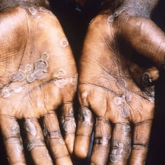 Viruela del Mono en México: casos confirmados y zonas afectadas