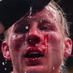 ¡Espeluznante! Así quedó la cara de Paddy Pimblett tras la pelea con Gaethje