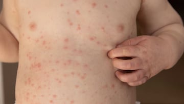 Secretaría de Salud confirma la primera muerte de sarampión en Durango. La víctima viajó a Sinaloa, tras su regreso a la entidad presentó síntomas graves y falleció.