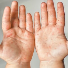 Golpe de la OMS a España: le retira el estatus de país libre de sarampión