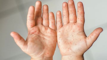 Conoce todos los síntomas que produce el virus del Sarampión y dónde vacunarte en México.