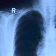 La diferencia entre la neumonía de la COVID y la convencional