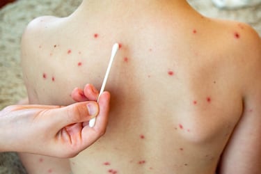 Estas son las precauciones que se recomiendan tomar por nuevo brote de sarampión en México