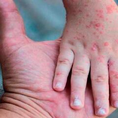 Viruela del Mono en México: Cuáles son los síntomas y medidas preventivas