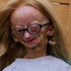 Muere Adalia Rose, la youtuber que padecía la enfermedad de Benjamin Button