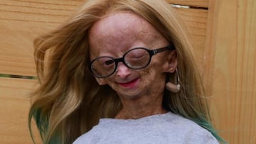 Muere Adalia Rose, la youtuber que padecía la enfermedad de Benjamin Button