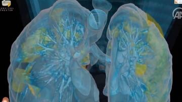 Los estragos del covid-19 en los pulmones en realidad virtual