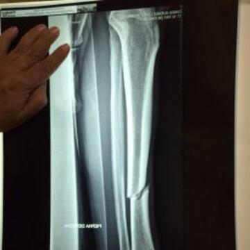 La radiografía muestra la fractura de tibia de Javier Güemez.