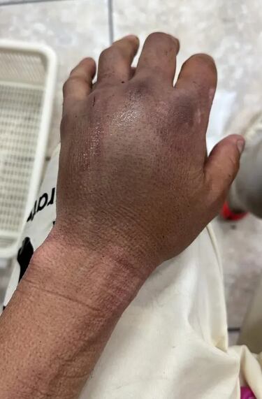 Muestran cómo quedó la mano de Rodrigo Ureña tras recibir un pisotón: impactante
