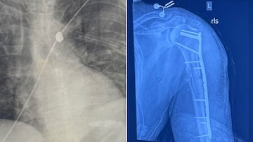 Radiografías del balazo a Merrill Roberts, cerca de la aorta.