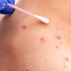 Viruela del Mono en México: Cuántos casos hay, medidas y síntomas al 2 de agosto