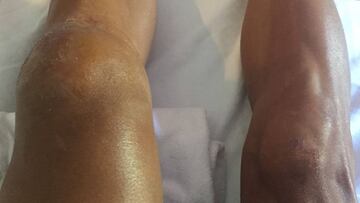 Imagen de las piernas de Philippe Gilbert tras la dura ca&iacute;da que sufri&oacute; en la 16&ordf; etapa del Tour de Francia.