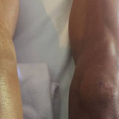 Gilbert rodó durante 60 kilómetros con la rodilla rota