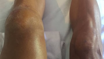 Imagen de las piernas de Philippe Gilbert tras la dura caída que sufrió en la 16ª etapa del Tour de Francia.