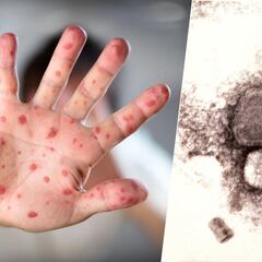 Viruela del mono en México: Qué es y cuáles son las medidas para evitar contraerlo