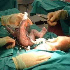 Aumentan los partos de bebés muertos durante la pandemia en todo el planeta