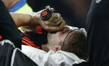 Las imágenes de la fractura de tibia de Luke Shaw