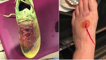 Así quedó el empeine de Lucas Pérez tras un pisotón