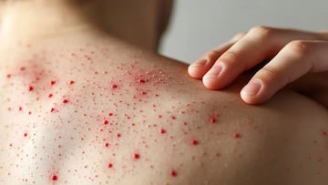 Secretaría de Salud de Chiapas recomienda suspender eventos masivos para evitar la propagación del Sarampión.