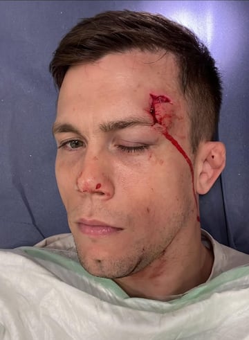 El luchador Daniel Bárez muestra la herida que sufrió en la ceja tras ser agredido con una medalla en Valencia.