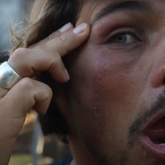 Un pequeño y exótico insecto le marca la cara a Nic Von Rupp