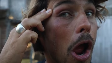 Picadura de escarabajo rove en la cara de Nic Von Rupp.