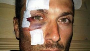 Basso sufre una caída y recibe 15 puntos en la cara