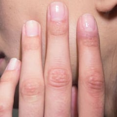 Las 'uñas COVID' se establecen como síntoma habitual: ¿Qué son?