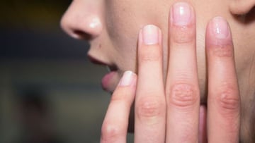 Las 'uñas COVID' se establecen como síntoma habitual: ¿Qué son?