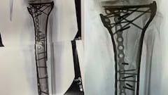 ¡No apto para sensibles! Así es la “nueva” pierna de Lindsey Vonn