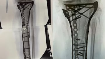 ¡No apto para sensibles! Así es la “nueva” pierna de Lindsey Vonn