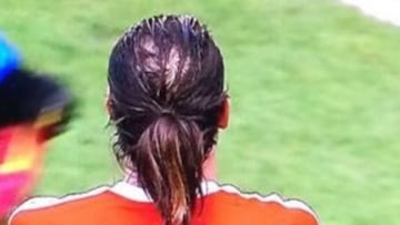 La alopecia de Bale 'preocupa' a los medios ingleses
