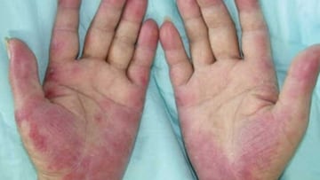 Las lesiones cutáneas, un 'chivato' para prevenir contagios