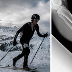 Kilian Jornet sufrió una fractura de peroné en la Pierra Menta