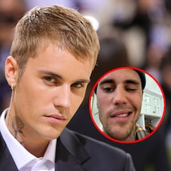 What is Ramsay Hunt Syndrome and how has it affected Justin Bieber?