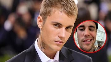 Justin Bieber explicó que tuvo que posponer algunos conciertos, ya que tiene el síndrome de Ramsay Hunt. Te explicamos qué es y cómo ha afectado su rostro.