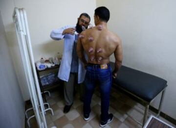 Visitamos el centro médico Shubra El-Kheima en el Cairo, Egipto, donde se realizan tratamientos tanto con sanguijuelas como con ventosas. Las ventosas ayudan a la circulación de la sangre y a aliviar la tensión muscular.